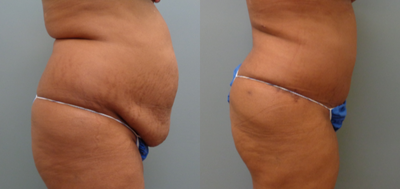 Tummy Tuck before and after photo