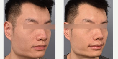 Asian Rhinoplasty before and after photo