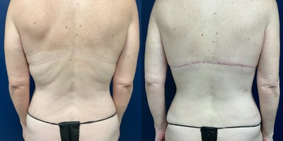 Back Lift before and after photo
