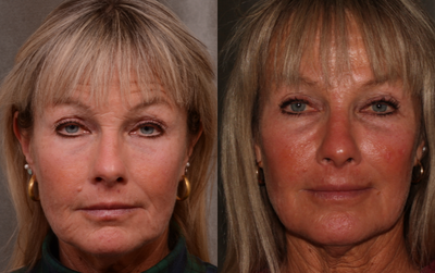 Botox before and after photo