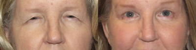 Brow Lift before and after photo