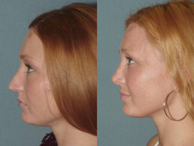 Rhinoplasty before and after photo