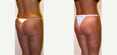 Body Lift before and after photo