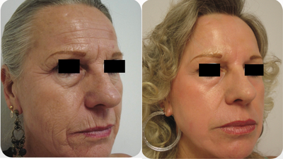 CO2 Laser before and after photo