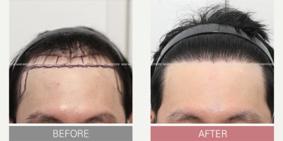 Hair Transplant before and after photo