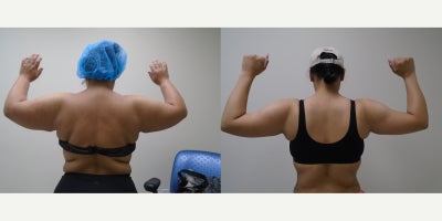 Laser Liposuction before and after photo