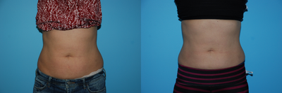 SculpSure before and after photo