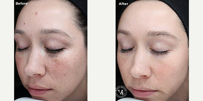 VI Peel before and after photo