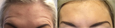 Botox before and after photo