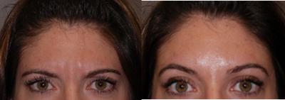 Botox before and after photo