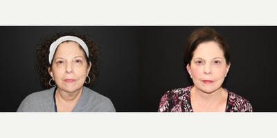Eyelid Surgery before and after photo