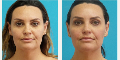 Lower Facelift before and after photo