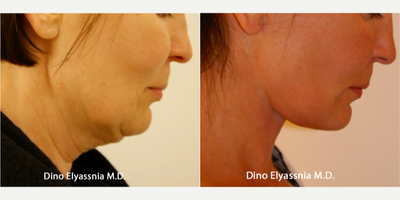 Neck Lift before and after photo