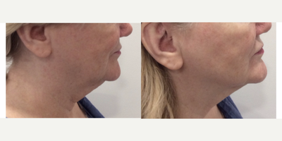 Nonsurgical Facelift before and after photo