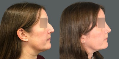 Rhinoplasty before and after photo
