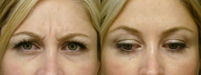 Botox before and after photo