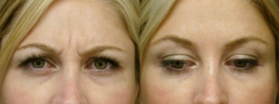 Botox before and after photo