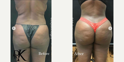 Brazilian Butt Lift before and after photo
