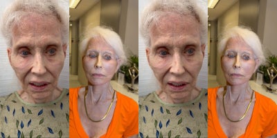 Facelift before and after photo