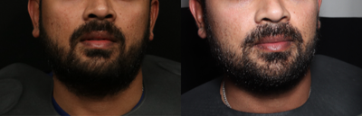 Microneedling before and after photo