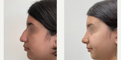 Rhinoplasty before and after photo