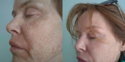 TCA Peel before and after photo