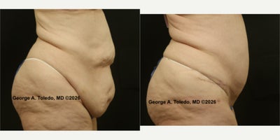 Tummy Tuck before and after photo