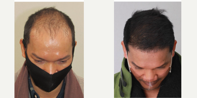 Hair Transplant before and after photo