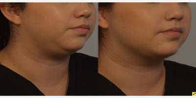 Kybella before and after photo