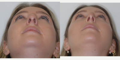 Revision Rhinoplasty before and after photo