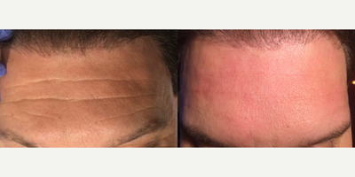 Belotero before and after photo