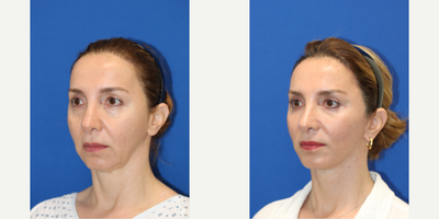 Deep Plane Facelift before and after photo