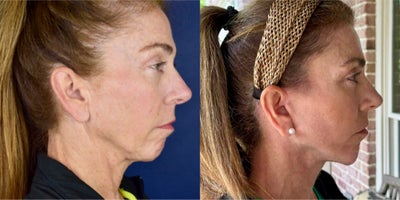Deep Plane Facelift before and after photo
