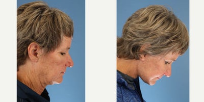 Eyelid Surgery before and after photo