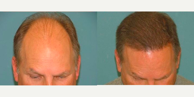 FUE Hair Transplant before and after photo