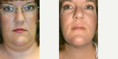 Liposuction before and after photo