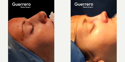 Rhinoplasty before and after photo