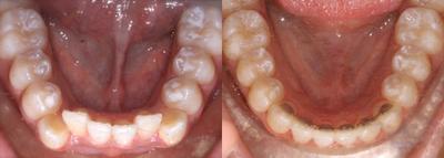 Braces before and after photo