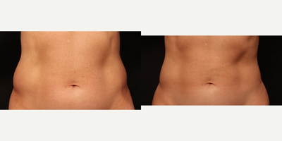 CoolSculpting before and after photo