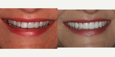Dental Implants before and after photo