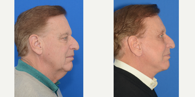 Facelift before and after photo