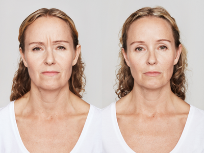 Dysport before and after photo