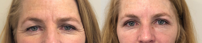 Eyelid Surgery before and after photo