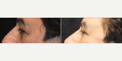 Eyelid Surgery before and after photo