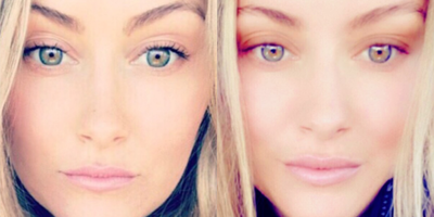 Lip Fillers before and after photo