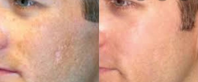 Microneedling before and after photo