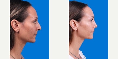 Rhinoplasty before and after photo
