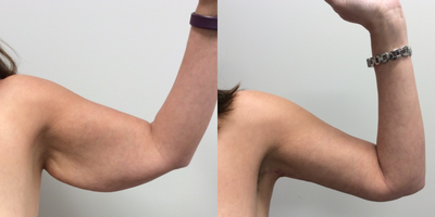 Arm Lift before and after photo