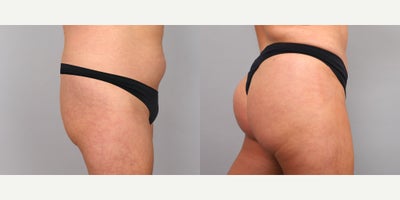Butt Lift before and after photo