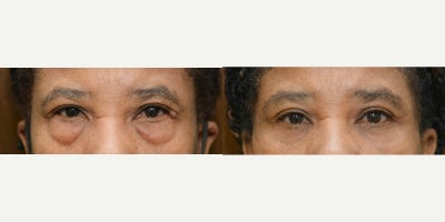 Eyelid Surgery before and after photo